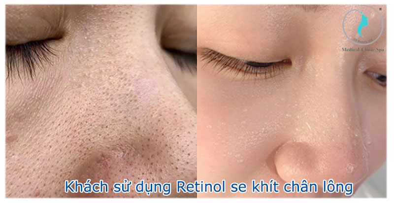 Hiệu quả khi sử dụng Retinol