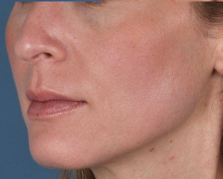Chuyển biến tích cực của bệnh nhân da nám sau khi dùng kem Tretin0in