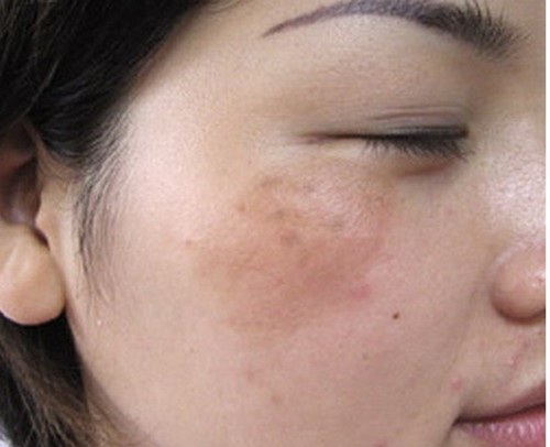 Nám chân sâu và cách điều trị chuẩn y khoa
