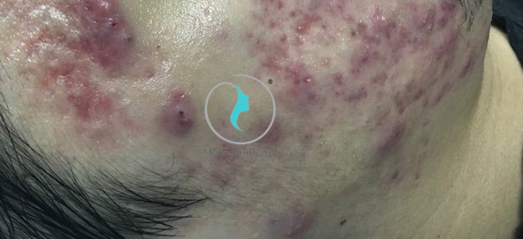 Hình ảnh Mụn mủ viêm