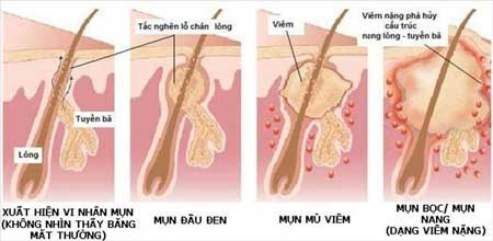 Quá trình hình thành mụn mủ viêm