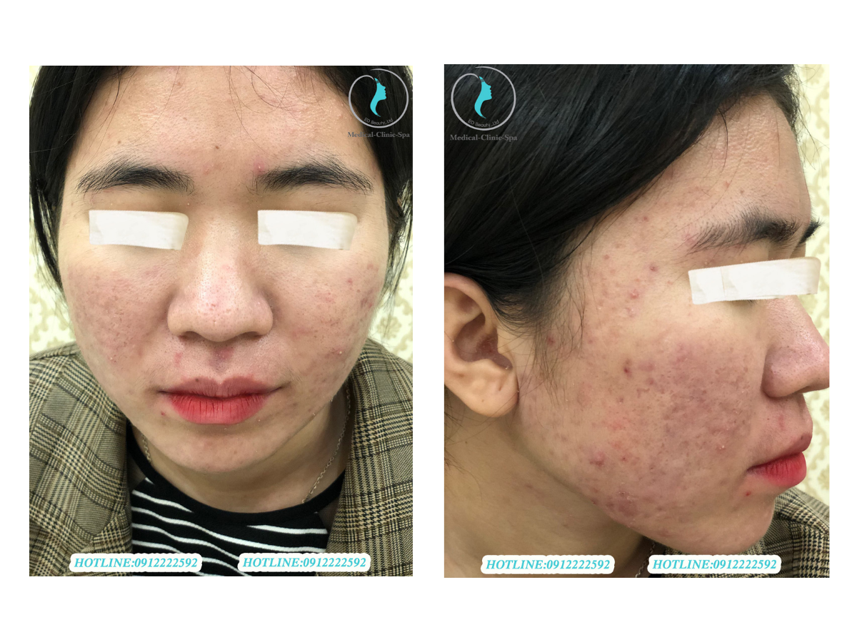 Khách trị mụn tại Ed Beauty