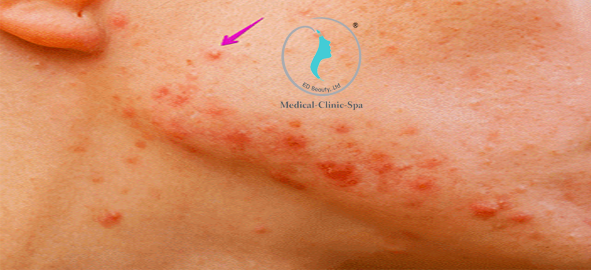 Biểu hiện của mụn mủ viêm