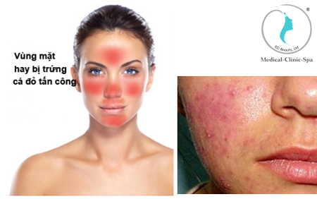 Biến chứng của trứng cá đỏ