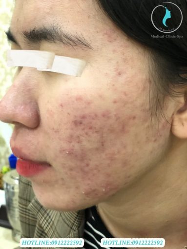 Biến chứng mụn mủ viêm