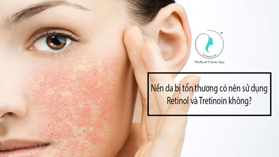 Nền da bị tổn thương có nên sử dụng Retinol và Tretinoin được không?