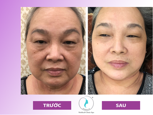 Kết quả của sử dụng công nghệ trẻ hóa da Thermage FLX sau liệu trình đầu tiên tại ED Beauty