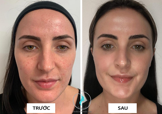 Hiệu quả trước và sau của bộ sản phẩm thay da sinh học Zo Skin Health 3-Step Peel