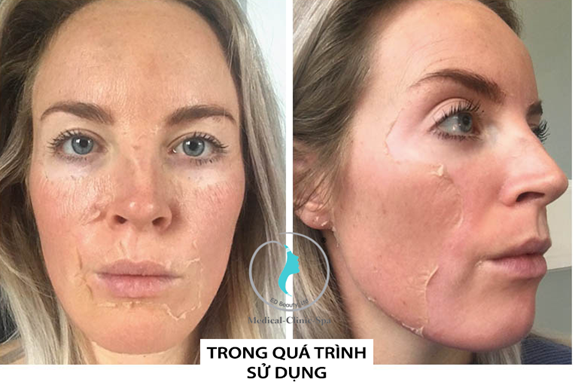 Trong quá trình sử dụng bộ sản phẩm thay da sinh học Zo Skin Health 3-Step Peel