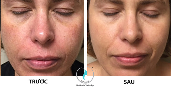 Hiệu quả điều trị da nám, tàn nhang Zo Pigment Control Program + Hydroquinone