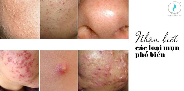 Nhận biết các loại mụn phổ biến