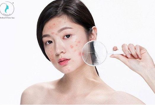 Bạn biết gì về mụn - kẻ thù của làn da?