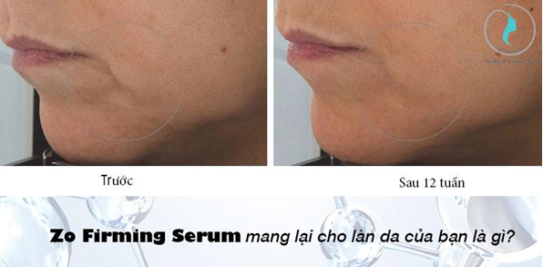 Hiệu quả vượt trội Zo Firming Serum mang lại cho làn da của bạn là gì?