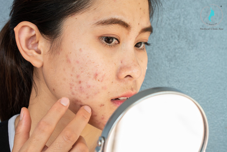 Bạn biết gì về mụn nội tiết?