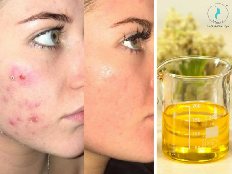 Tìm hiểu về chiết xuất Hoa Anh Thảo đối với da mụn?