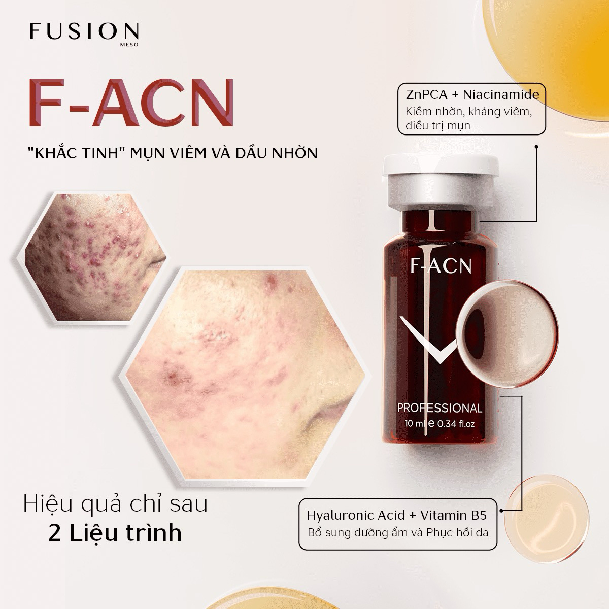 Tiêm trị mụn Fusion Mesotherapy F-ACN