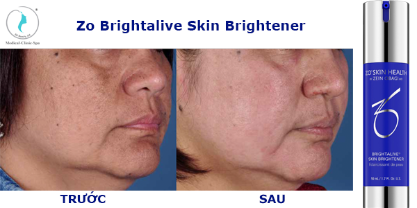 Kết quả bất ngờ sau 2 tuần sử dụng Zo Brightalive Skin Brightener