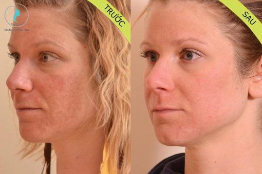 Kem trị nám Triluma Cream thích hợp với nền da khỏe, gặp phải tình trạng nám mảng.