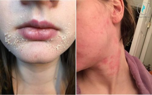 Các tác dụng phụ khi dùng kem trị nám Triluma Cream