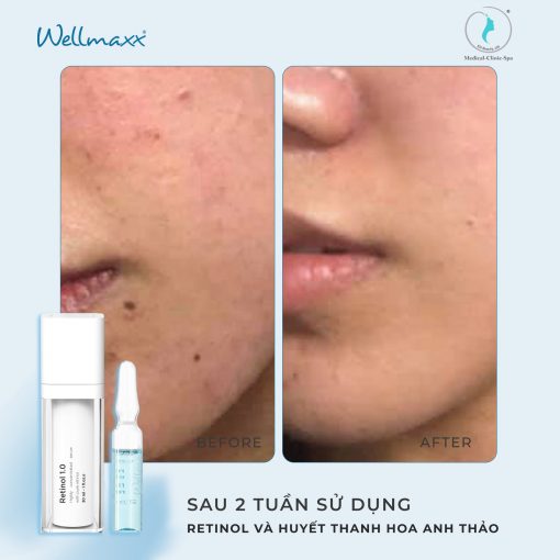 Kết hợp huyết thanh hoa anh thảo Wellmaxx với Retinol / BHA