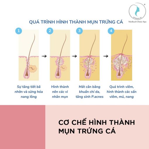 Cơ chế thành mụn trứng cá