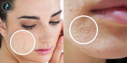 Tình trạng bong tróc kéo dài khi dùng Retinol