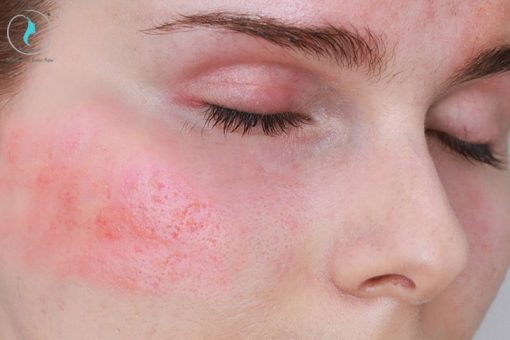 Tình trạng vùng da mắt/gò má căng rát, châm chích, ửng đỏ khi dùng Retinol