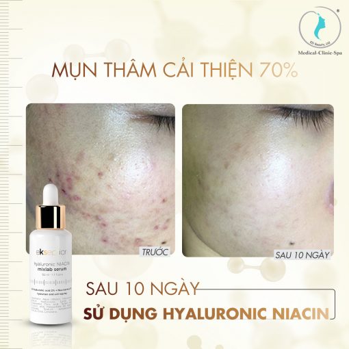 Tạm biệt mụn và thâm mụn sau 10 ngày với Serum Ekseption Niacin
