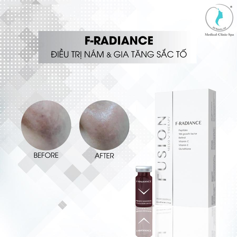 Điều trị nám và tăng sắc tố Fusion Meso F-Radiance