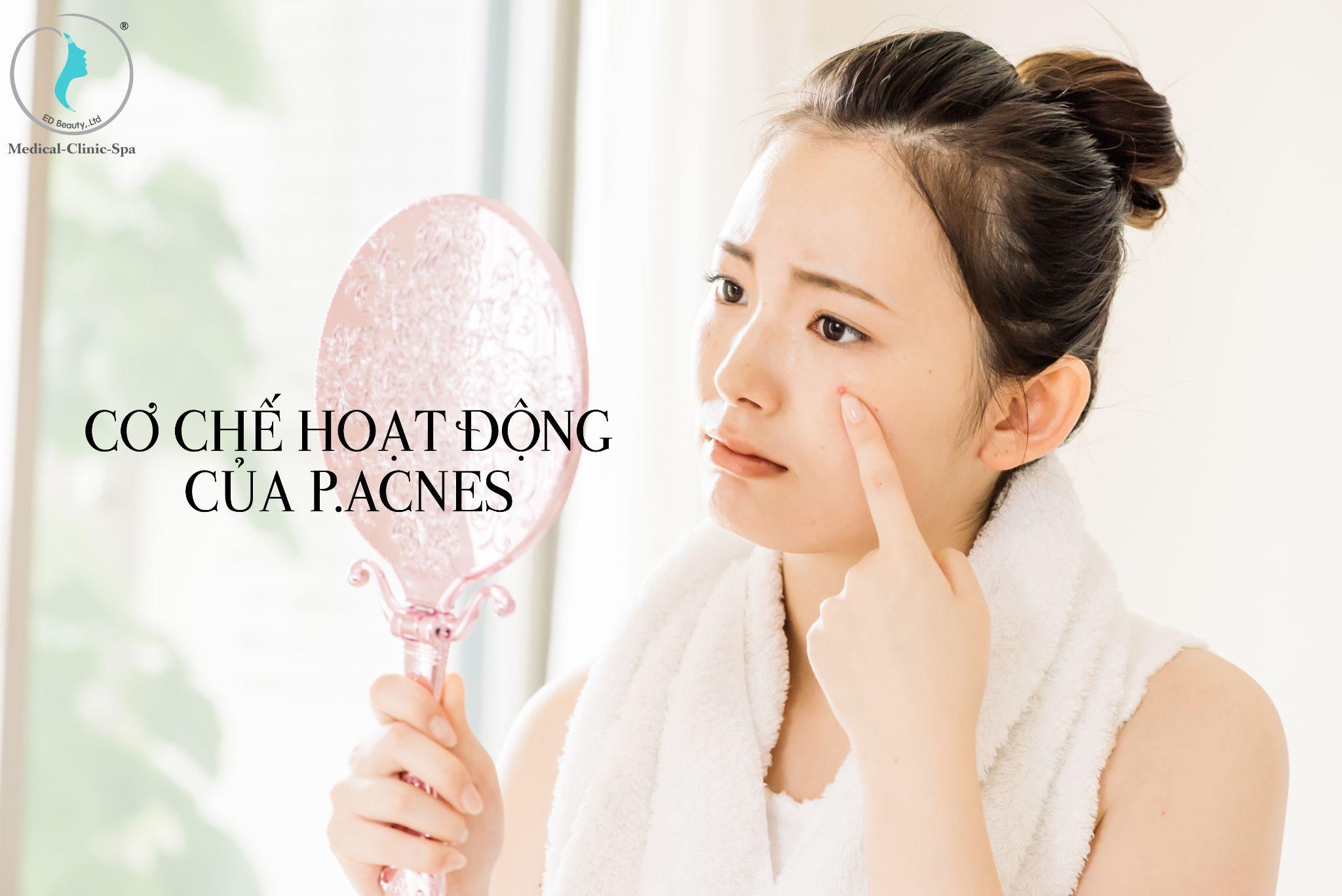 Vi khuẩn P.Acnes là nguyên nhân chính gây ra mụn trên da