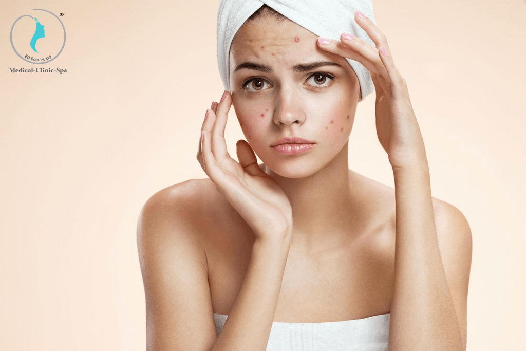 Nổi mụn viêm khắp mặt do dùng Retinol không đúng cách