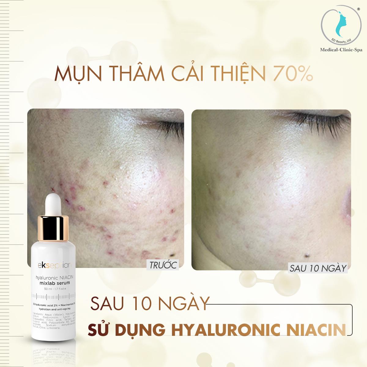 Ekseption Niacin Serum phù hợp cho làn da mụn