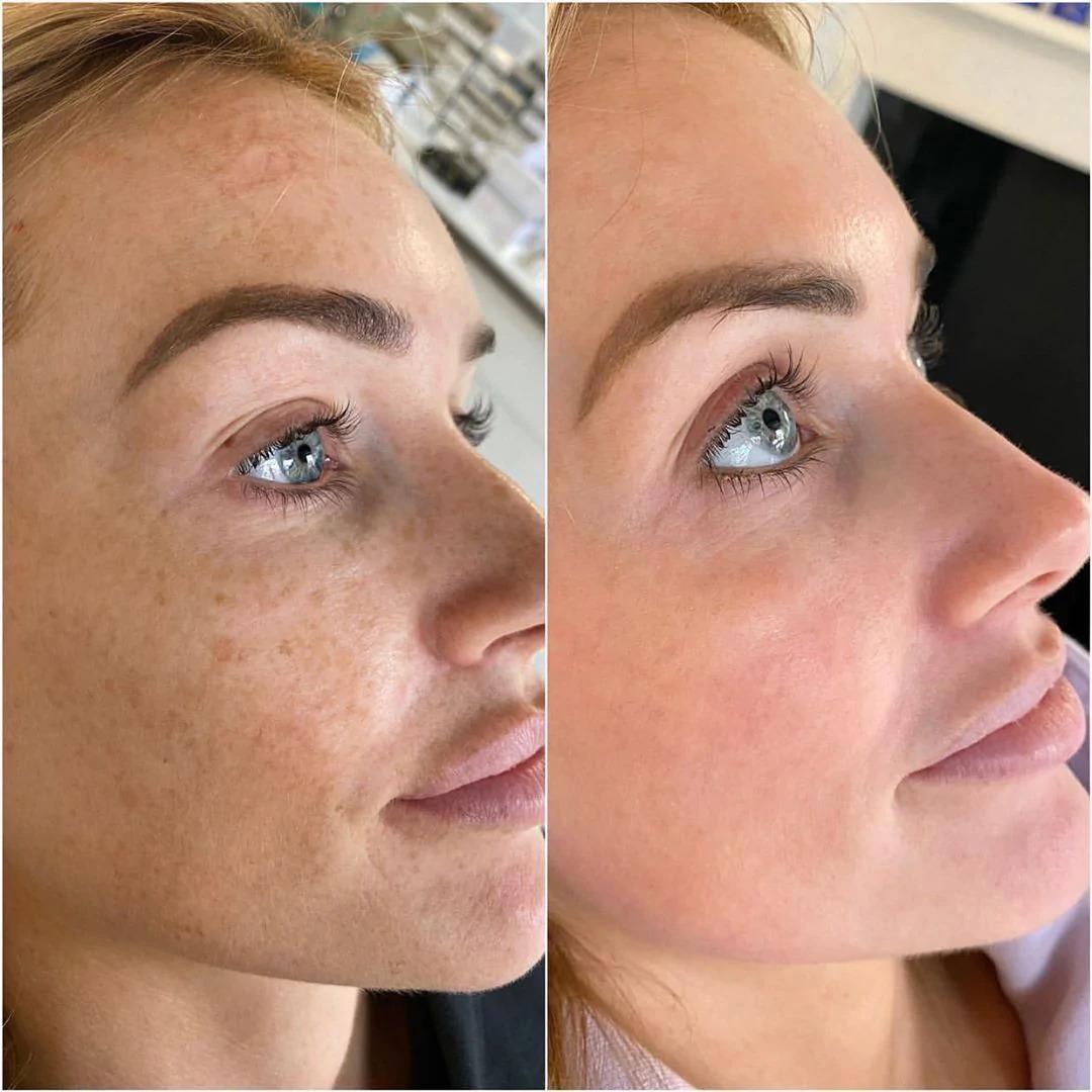 Tác dụng của kem giảm nám Mesoestetic Dermamelan Treatment