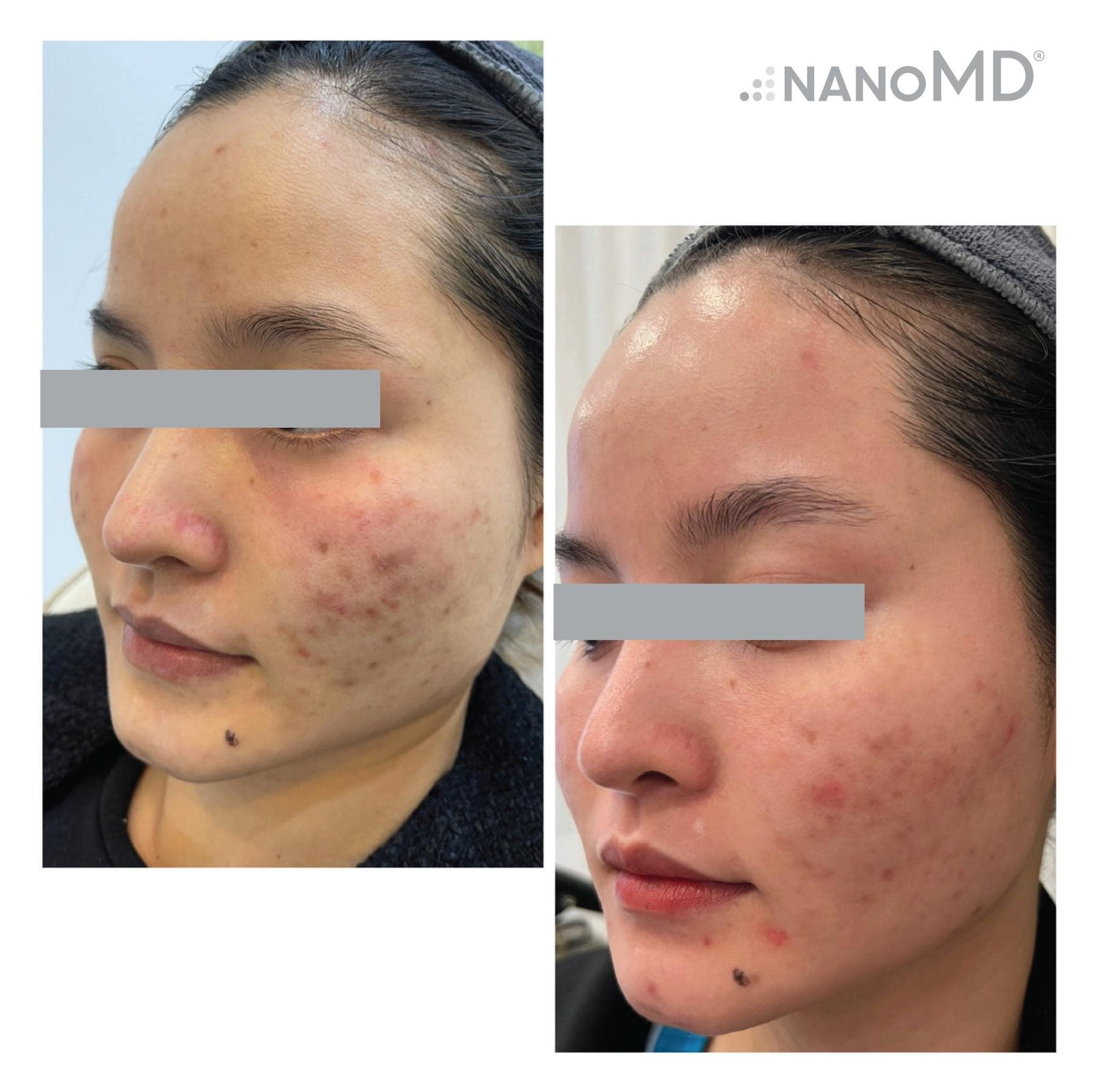 Hiệu quả sau khi sử dụng viên uống Nano MD BRIT-N
