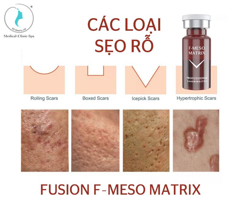 Meso Fusion F- Matrix sản phẩm điều trị sẹo rỗ