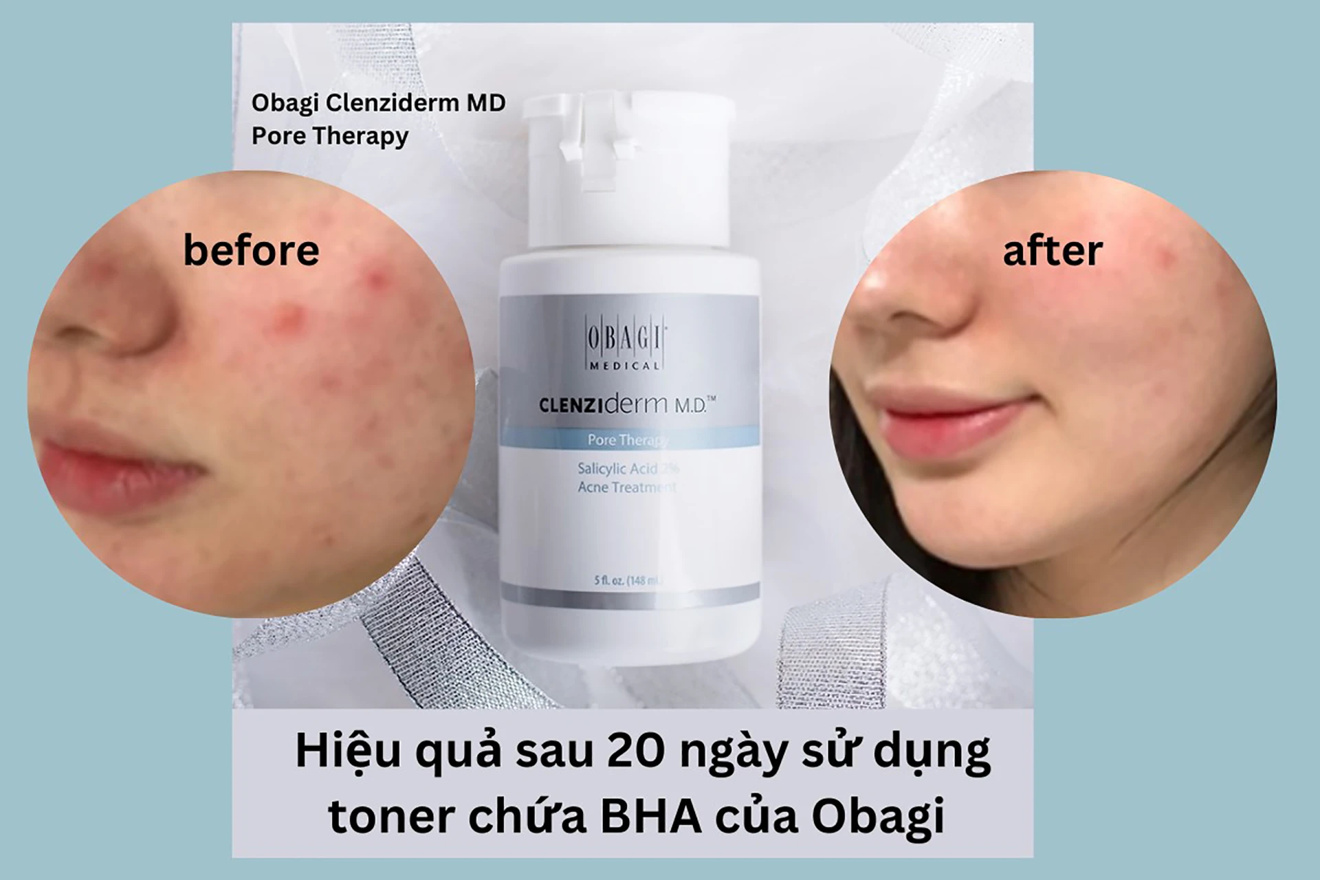 BHA OBAGI giảm dầu mụn